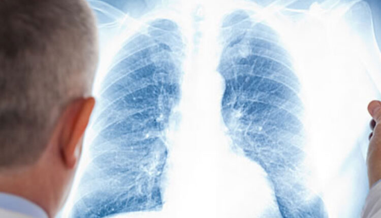 lung cancer new photo